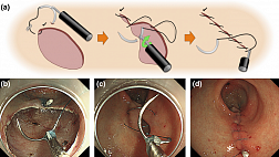 Рекомендации по закрытию дефектов после эндоскопической резекции слизистой